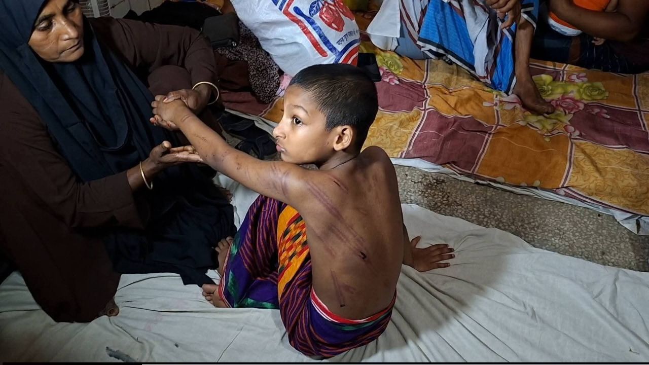 সামান্য কারণে বেত্রাঘাত, মাদরাসায় শিশুর শরীরজুড়ে ক্ষতচিহ্ন